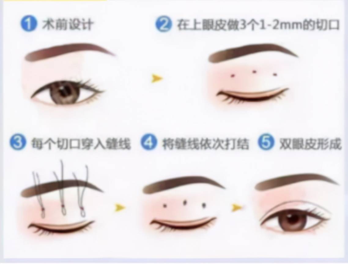 想割双眼皮（想要做双眼皮手术有哪些方法？）