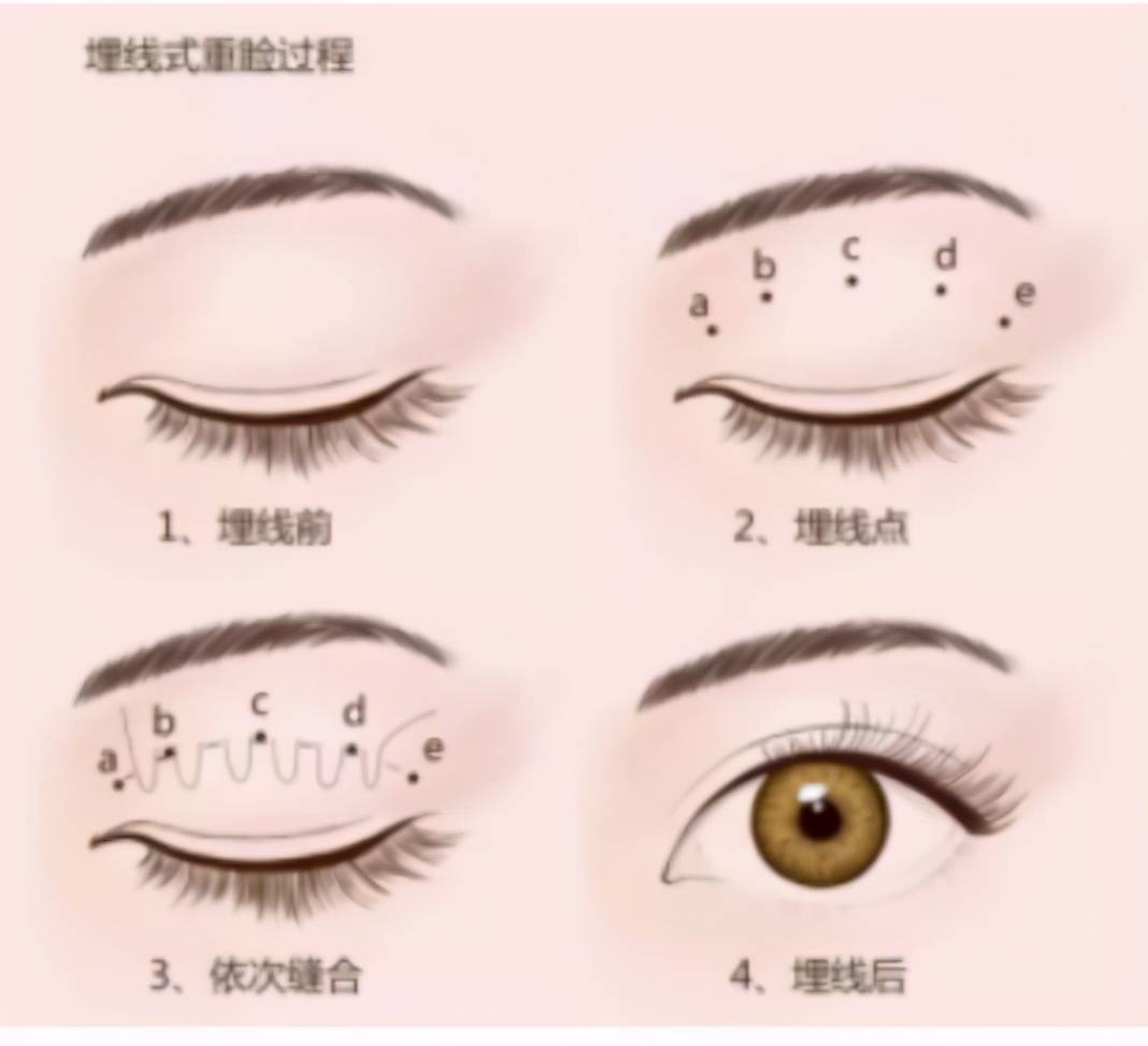 想割双眼皮（想要做双眼皮手术有哪些方法？）