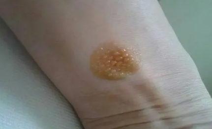 艾灸起了水泡还能灸吗