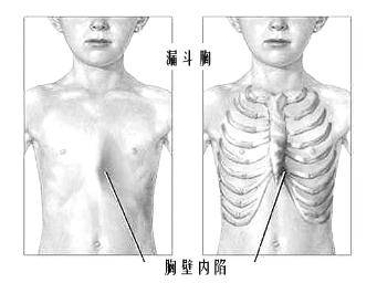 佝偻病的症状（佝偻病的症状和临床特点）