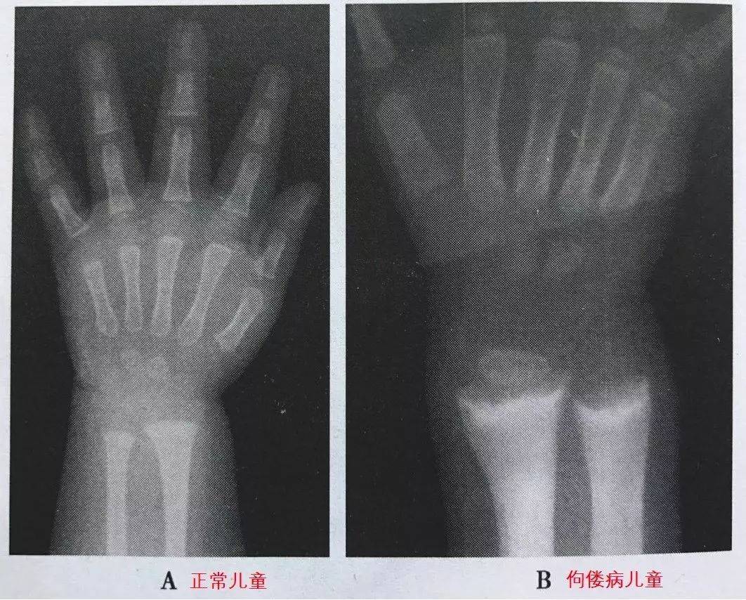 佝偻病的症状（佝偻病的症状和临床特点）