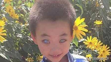 青光眼的症状(形形色色的青光眼)