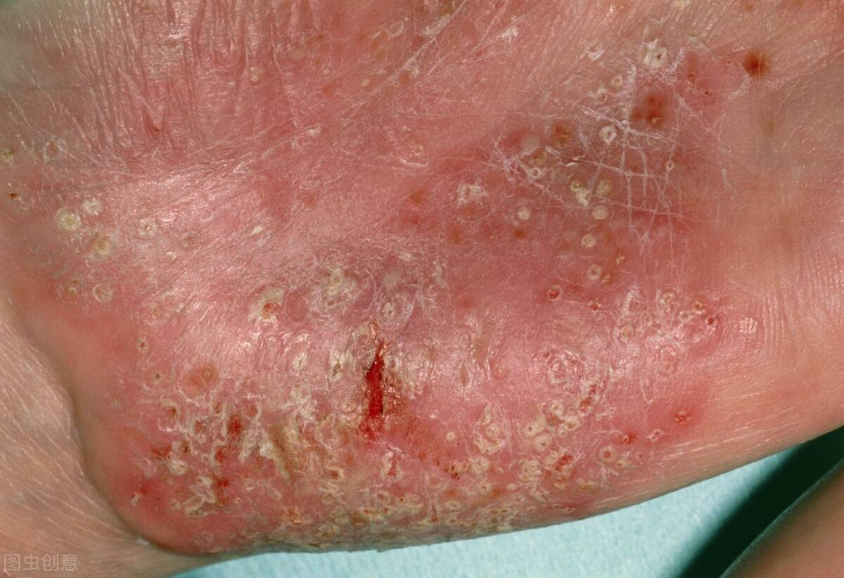 湿疹中药(中医认为湿疹有哪几种?)