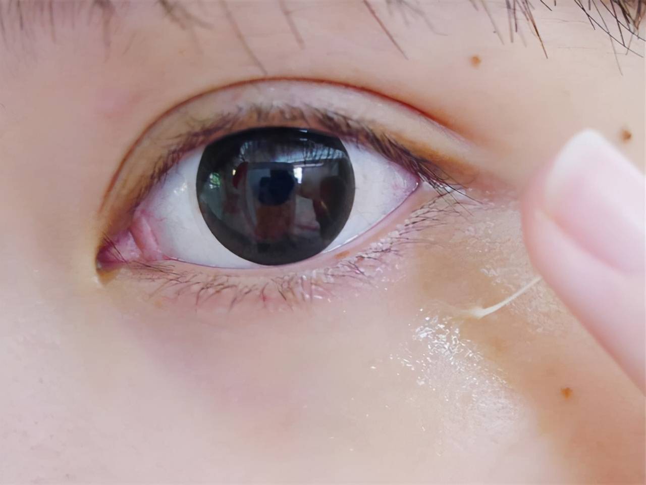 眼周细纹（如何去除眼下细纹）