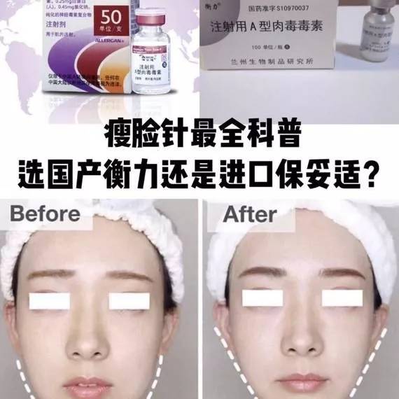 国产瘦脸针和进口区别(国产和进口瘦脸针有什么区别?)