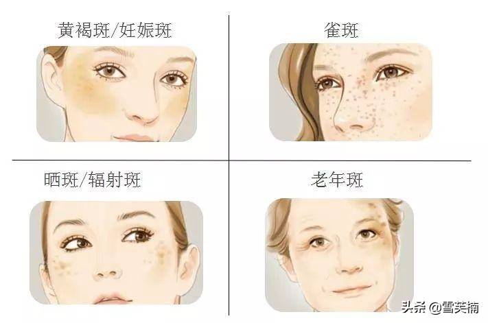 怎样才能去除黄褐斑（黄褐斑怎么去除效果好？）