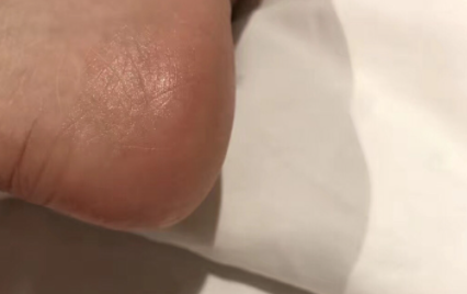 脚后跟硬皮用什么泡