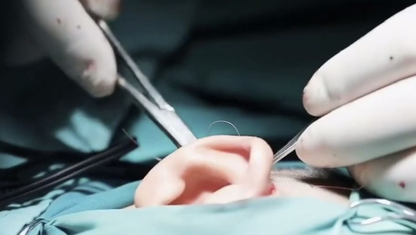 肋骨再造耳朵能用一辈子吗2