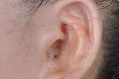 肋骨再造耳朵能用一辈子吗3