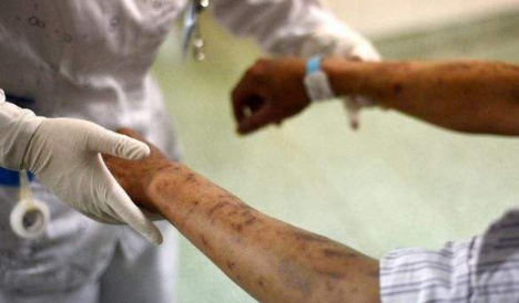 什么样的红点是艾滋病