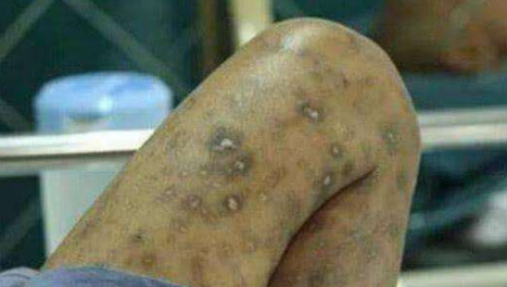 什么样的红点是艾滋病