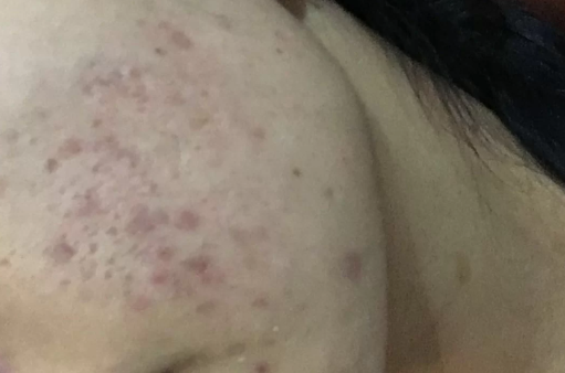 痤疮的红印会不会一直不消失