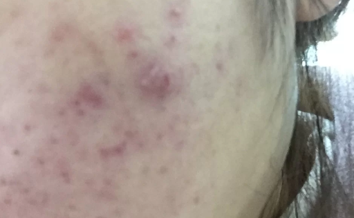 痤疮的红印会不会一直不消失