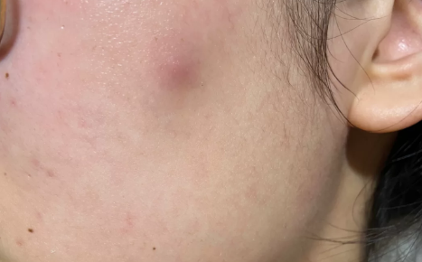 痘痘已经平了一直红着可以化妆吗