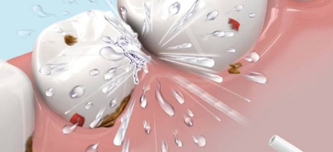 冲牙器只能冲牙齿正面吗