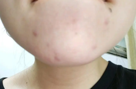 下巴长痘痘是哪里的问题