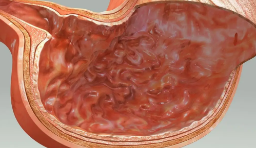 胃癌的发生与生活习惯密切相关吗