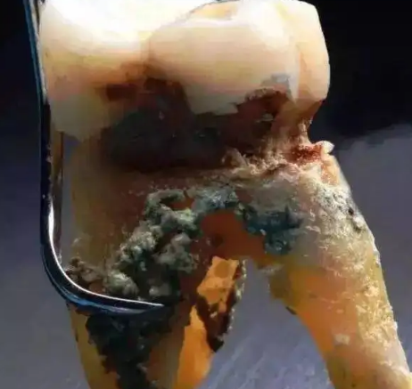 牙结石是什么样的图片