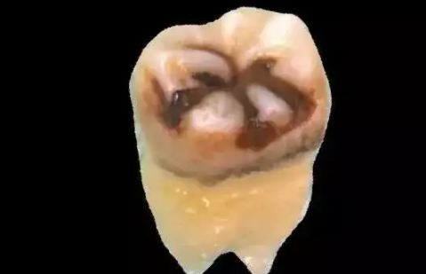 牙结石自然脱落正常吗