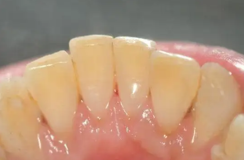 牙结石自然脱落正常吗