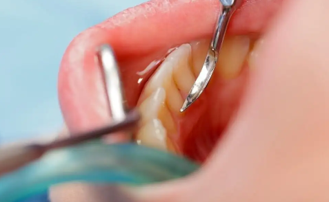 抠牙结石工具叫什么