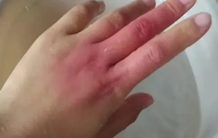 烫伤用什么方法好的最快