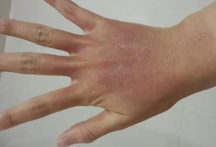 烫伤用什么方法好的最快