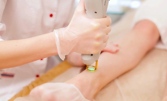 激光脱毛会引起狐臭吗