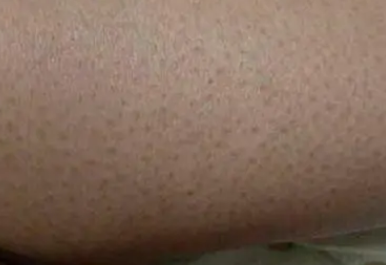 鸡皮肤怎么消除