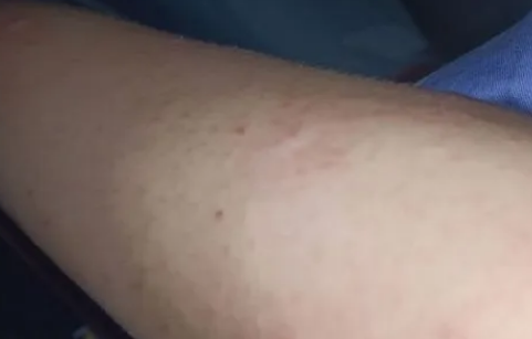 鸡皮肤怎么消除