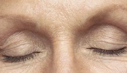 如何去掉眼底皱纹