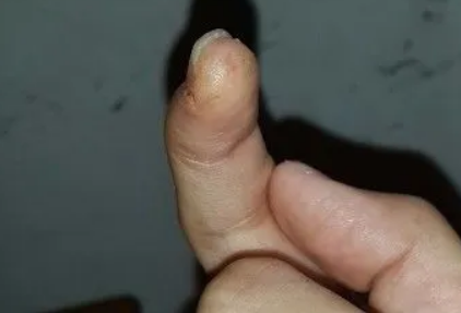 手指缝脱皮是梅毒吗