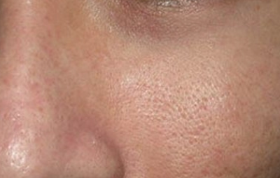 运动能收缩毛孔吗