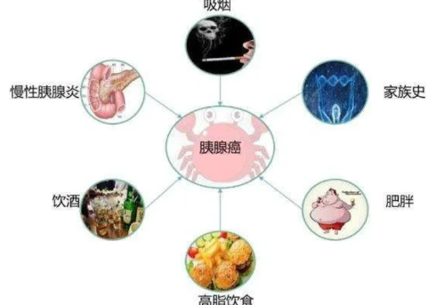 很多胰腺癌都是误诊吗