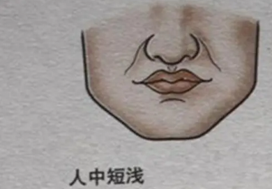 人中上的痣能去掉吗