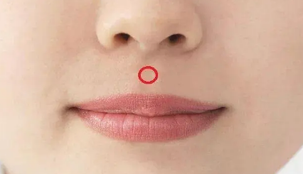 人中上的痣能去掉吗