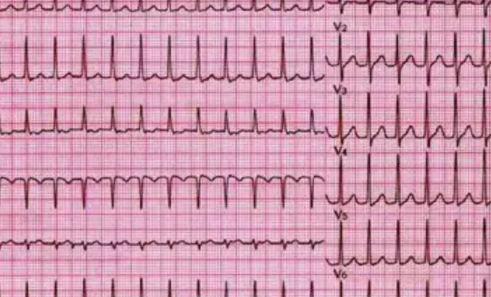 窦性心律不齐公务员体检能过关吗