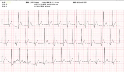 窦性心律不齐公务员体检能过关吗