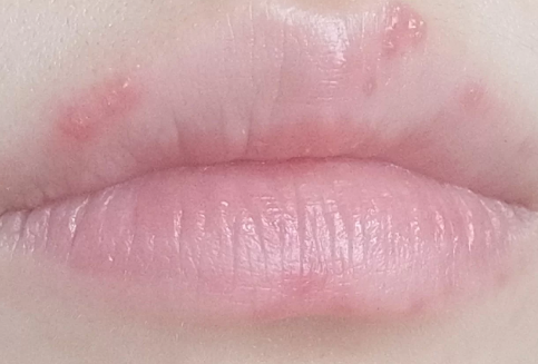 嘴唇疱疹过后为什么刺痛肿胀