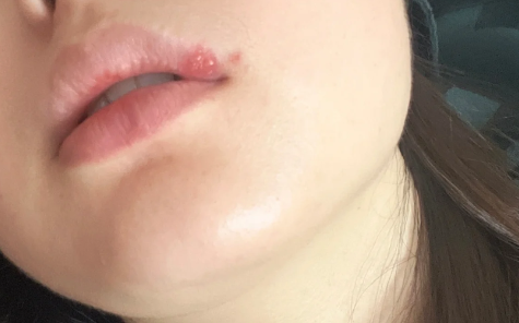 带状疱疹结痂后里面有脓咋办