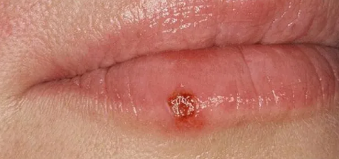 嘴唇疱疹结痂了能见水吗