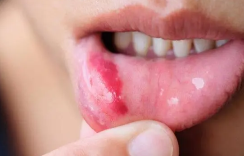 嘴唇疱疹嘴巴烂了吃不了饭怎么办