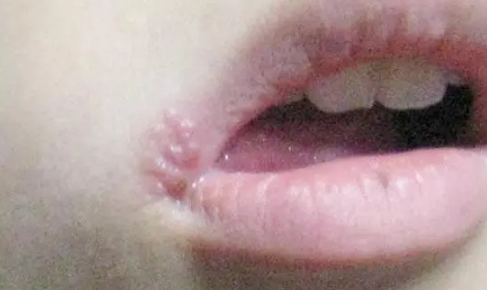嘴唇疱疹嘴巴烂了吃不了饭怎么办