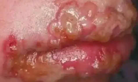 嘴唇起疱疹之后干巴巴的涂抹啥