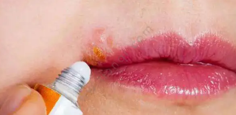 唇疱疹好后嘴巴反复蜕皮怎么回事
