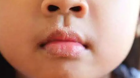 唇疱疹好后嘴巴反复蜕皮怎么回事