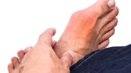 免疫吸附治痛风是用机器吗