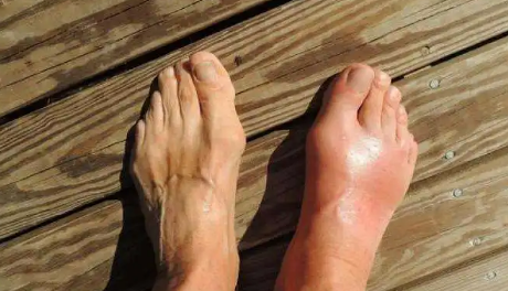 免疫吸附治痛风是用机器吗