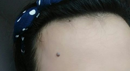 嘴巴下的痣可以去掉吗