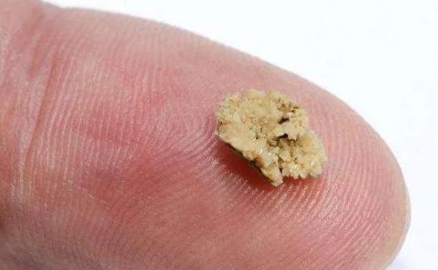 肾结石三毫米可以碎吗